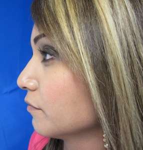 Rhinoplasty Before & After Patient #10269
