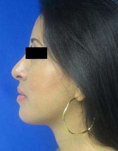 Rhinoplasty Before & After Patient #10272