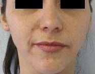 Rhinoplasty Before & After Patient #10280