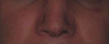 Rhinoplasty Before & After Patient #10283