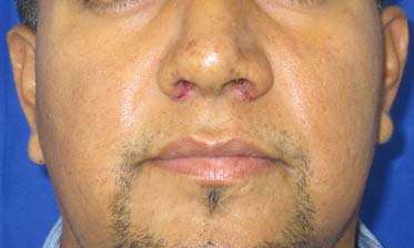 Rhinoplasty Before & After Patient #10288