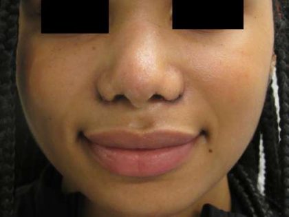 Rhinoplasty Before & After Patient #10296