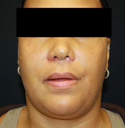 Rhinoplasty Before & After Patient #10299