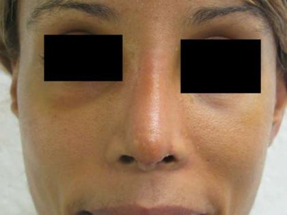 Rhinoplasty Before & After Patient #10318