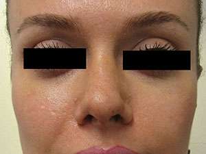 Rhinoplasty Before & After Patient #10321