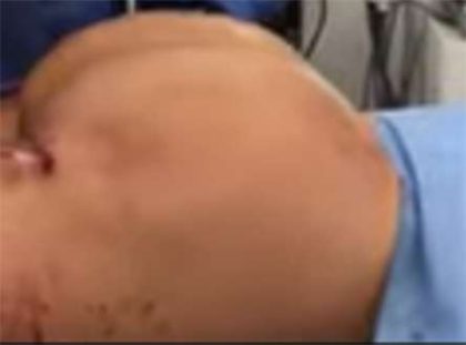 Silicone Injections Biopolymer Removal Before & After Patient #10324