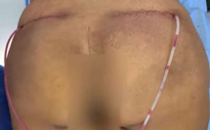 Silicone Injections Biopolymer Removal Before & After Patient #10327
