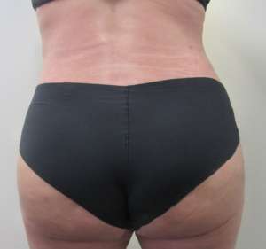 Brazilian Butt Lift Before & After Patient #6345