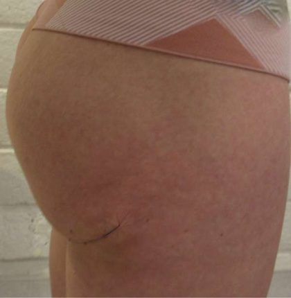 Thigh Lift Before & After Patient #10350