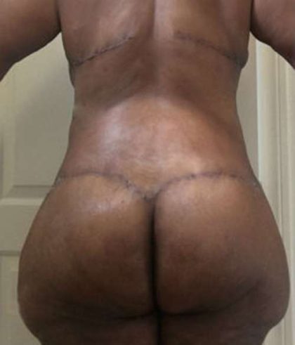 Thigh Lift Before & After Patient #10360