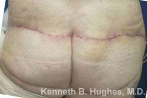 Thigh Lift Before & After Patient #10371