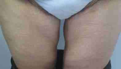 Thigh Lift Before & After Patient #10380