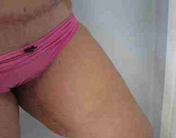 Thigh Lift Before & After Patient #10383