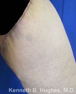 Thigh Lift Before & After Patient #10397