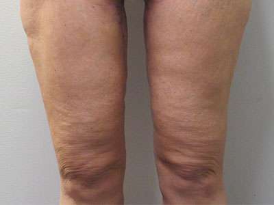Thigh Lift Before & After Patient #10400
