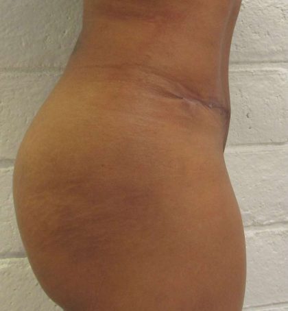 Tummy Tuck Before & After Patient #10410