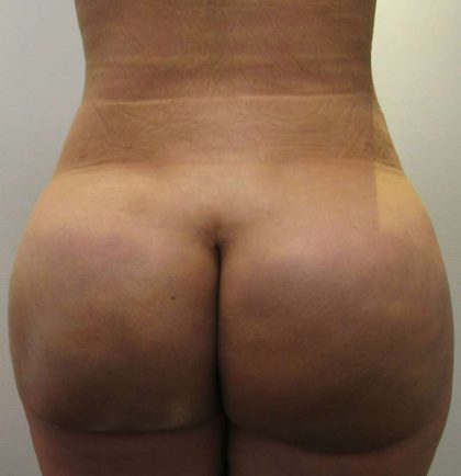 Brazilian Butt Lift Before & After Patient #6358