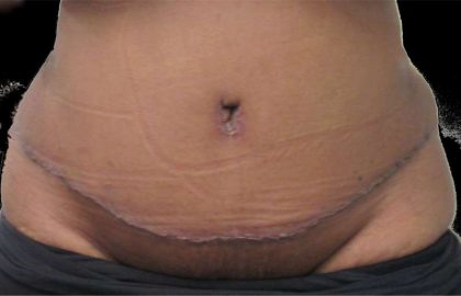 Tummy Tuck Before & After Patient #10418