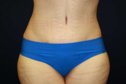 Tummy Tuck Before & After Patient #10423