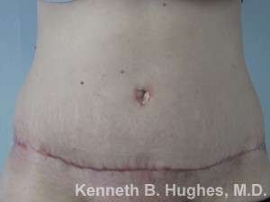Tummy Tuck Before & After Patient #10430