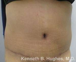 Tummy Tuck Before & After Patient #10439