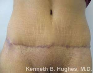 Tummy Tuck Before & After Patient #10447