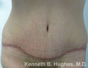 Tummy Tuck Before & After Patient #10456