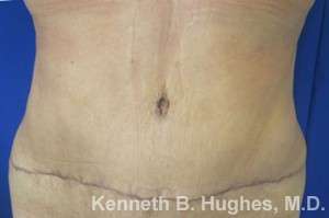 Tummy Tuck Before & After Patient #10459