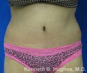 Tummy Tuck Before & After Patient #10462