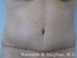 Tummy Tuck Before & After Patient #10471