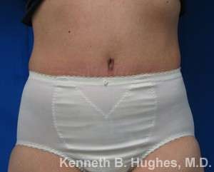 Tummy Tuck Before & After Patient #10474