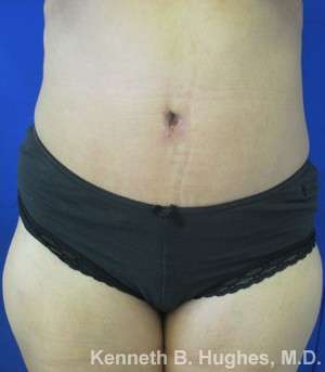 Tummy Tuck Before & After Patient #10477