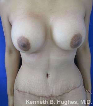 Tummy Tuck Before & After Patient #10482