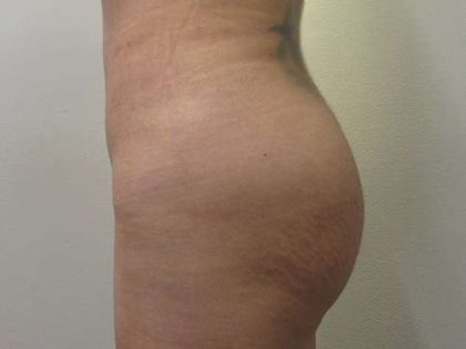 Brazilian Butt Lift Before & After Patient #6364