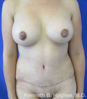 Tummy Tuck Before & After Patient #10485
