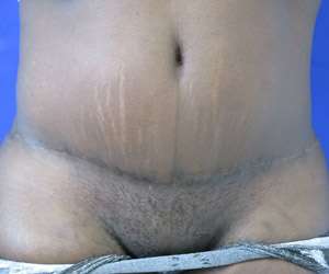 Tummy Tuck Before & After Patient #10495