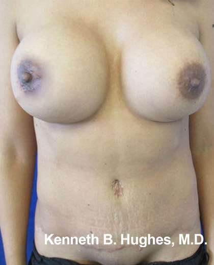 Tummy Tuck Before & After Patient #10498