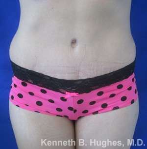 Tummy Tuck Before & After Patient #10508