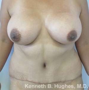 Tummy Tuck Before & After Patient #10517