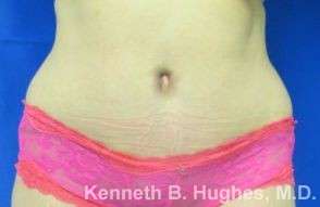 Tummy Tuck Before & After Patient #10520