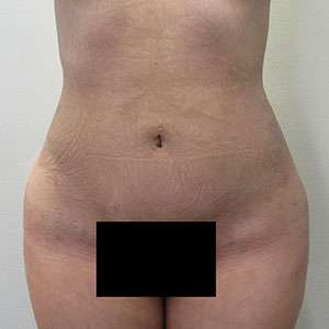 Brazilian Butt Lift Before & After Patient #6369