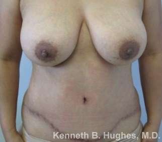 Tummy Tuck Before & After Patient #10526