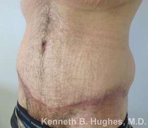 Tummy Tuck Before & After Patient #10534