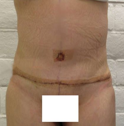Tummy Tuck Before & After Patient #10542