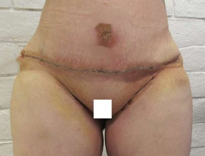 Tummy Tuck Before & After Patient #10545