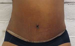 Tummy Tuck Before & After Patient #10548