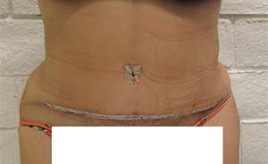 Tummy Tuck Before & After Patient #10551