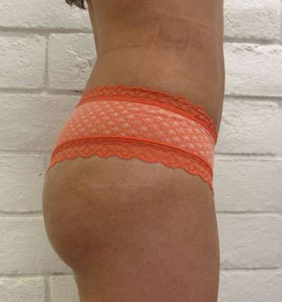 Brazilian Butt Lift Before & After Patient #6378