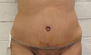 Tummy Tuck Before & After Patient #10557