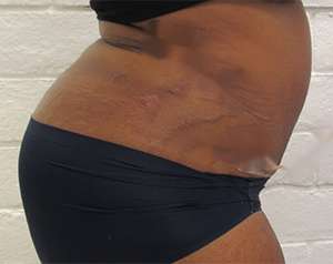Tummy Tuck Before & After Patient #10560